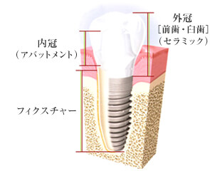 インプラント治療