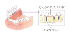インプラント治療