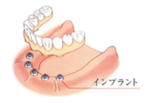 インプラント治療