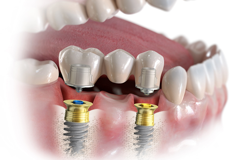 治療例 奥歯を含めて複数の歯を失った場合
