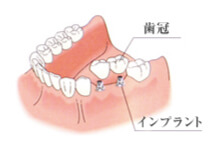一宮市のインプラントクリニック・オーキッド歯科の1~2本のインプラント治療例
