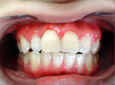 一宮市のインプラントクリニック・オーキッド歯科のセラミックラミネート施術例