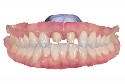 一宮市のインプラントクリニック・オーキッド歯科の３Dフルカラーのスキャニング「TRIOS3」は高精度・リアルな色調再現