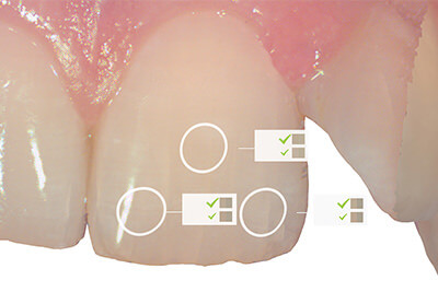 一宮市のインプラントクリニック・オーキッド歯科の３Dフルカラーのスキャニング「TRIOS3」はシェード測定