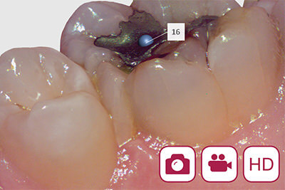 一宮市のインプラントクリニック・オーキッド歯科の３Dフルカラーのスキャニング「TRIOS3」はHD（High definition）フォト機能