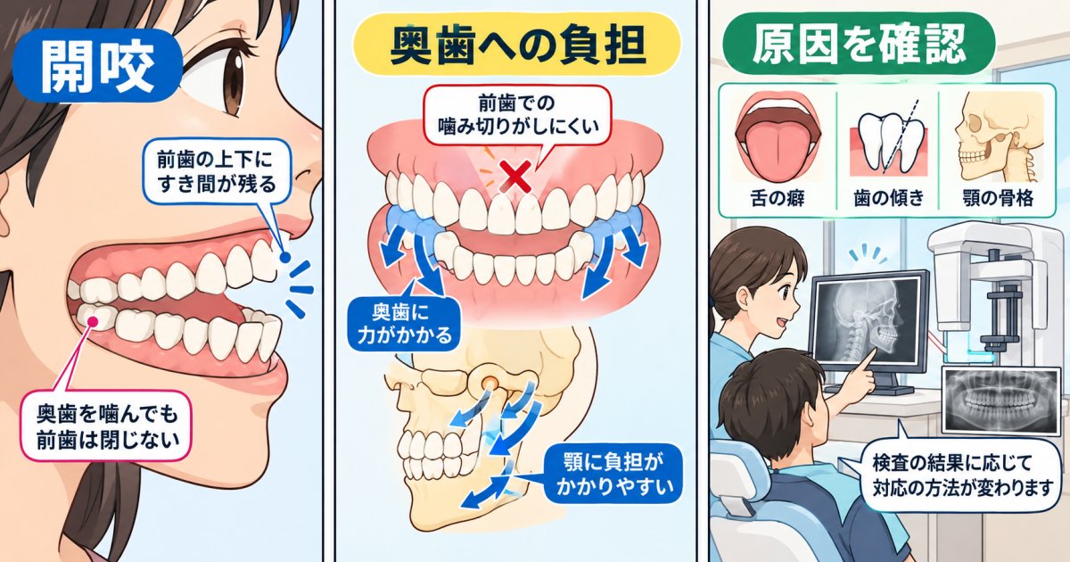 前歯が噛み合わない開咬のリスクと、奥歯への負担や原因別の対処法