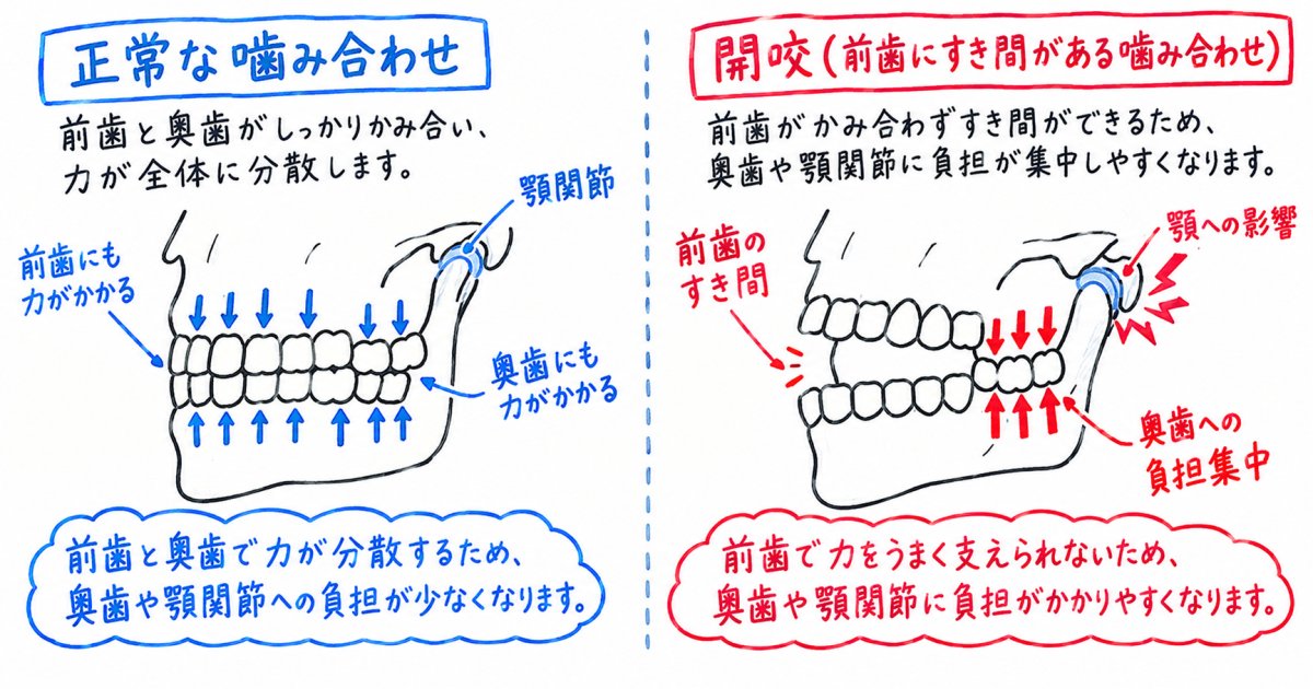 前歯が噛み合わない開咬には、奥歯や顎にどんなリスクがある?